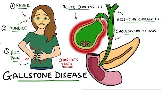 Gallstone Disease  Acute Cholecystitis vs Cholelithiasis vs Choledocholithiasis vs Cholangitis [upl. by Hallie]