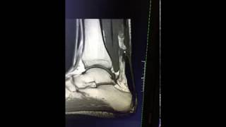 Achilles Tendon Rupture  MRI findings [upl. by Nevaj]