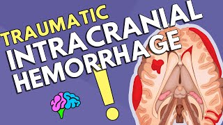 Intracranial Hemorrhage [upl. by Arihsak147]