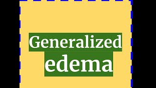 GENERALIZED EDEMA [upl. by Cherianne421]