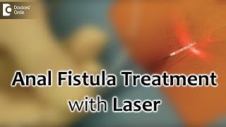 Anal Fistula Treatment with Laser Painless and best recovery for fistula  Dr Rajasekhar M R [upl. by Colline]