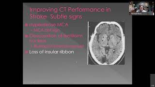 Stroke The Role of CT and MRI in Diagnosis and Treatment [upl. by Akitahs]