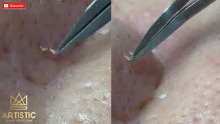 blackheads filaments on nose remove with tweezers กดสิว [upl. by Aisena948]