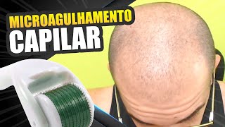 Microagulhamento capilar masculino funciona Usei com minoxidil [upl. by Felicie]