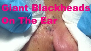 Giant Blackheads  Part I [upl. by Aisetra]