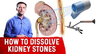 How To Dissolve Kidney Stones Explained By DrBerg [upl. by Cnahc]