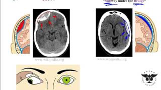 Intracranial Hemorrhage EpiduralSubduralSubarachnoid overview [upl. by Toback3]