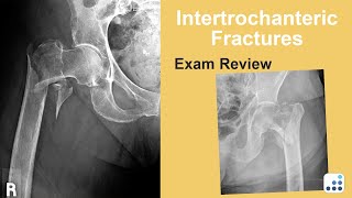 Intertrochanteric Fractures Exam Review  Bohannon Mason MD [upl. by Perl]