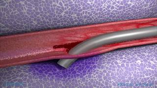 Peripheral IV Infiltration Animation [upl. by Renfred]