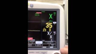 Capnography EtCO2 Monitoring [upl. by Huberto]