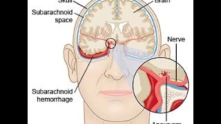 Subarachnoid Hemorrhage [upl. by Anabahs]