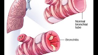 Wheeze Bronchiolitis [upl. by Emse]