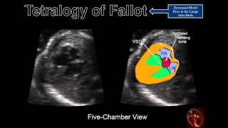 TMT Fetal Cardiac Evaluation  Part I by Dr Alpana Joshi [upl. by Boni220]