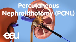 Removal of kidney stones PCNL [upl. by Sauveur452]