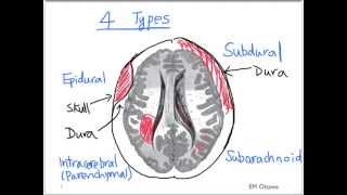 Intracranial Bleed  Part 1 [upl. by Lilaj]