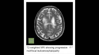 Progressive Multifocal Leukoencephalopathy PML [upl. by Llewop]