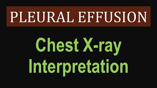 Pleural Effusion  Chest Xray Interpretation [upl. by Ahsienod]