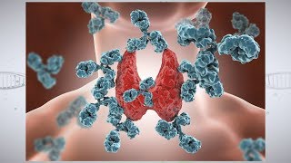 How to identify subclinical hypothyroidism [upl. by Oirramaj747]