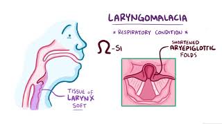 Laryngomalacia causes symptoms diagnosis treatment pathology [upl. by Kelwin]