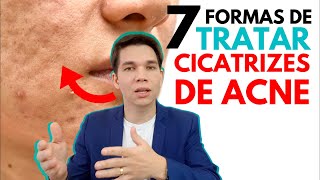 As 7 MELHORES maneiras de TRATAR Cicatrizes de Acne [upl. by Bouley791]