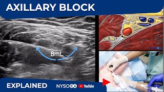 Ultrasound Guided Axillary Brachial Plexus Block NYSORA Regional Anesthesia [upl. by Whitehouse]