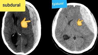 Epidural hematoma CT [upl. by Rebak]