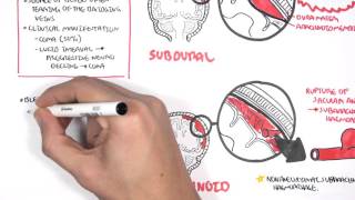 Hemorrhagic stroke epidural amp subdural hematoma  USMLE Step 1 [upl. by Alohs]