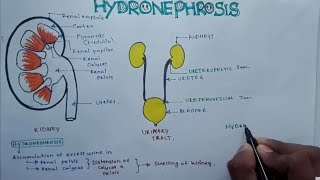 HYDRONEPHROSIS  Pathophysiology Causes signs and symptoms background diagnosis and treatment [upl. by Lisk]