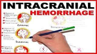 Hemorrhagic Stroke  Intracerebral Hemorrhage amp Subarachnoid Hemorrhage  Management [upl. by Sutton809]