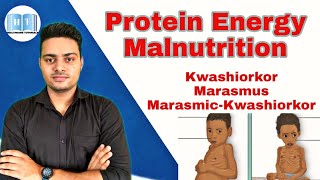 Protein Energy Malnutrition  Kwashiorkor Vs Marasmus [upl. by Klapp]