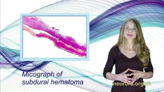 Subdural hematoma [upl. by Annhej635]