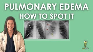 Pulmonary Edema Chest Xray [upl. by Balough]