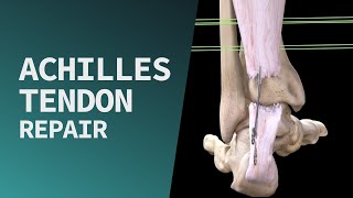 Achilles Tendon Repair [upl. by Flanna]