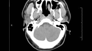 Introduction to the CT Brain [upl. by Calla]