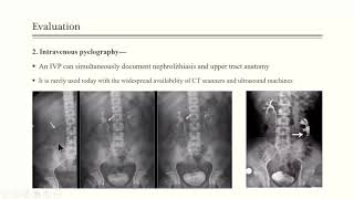 Urolithiasis [upl. by Ais]