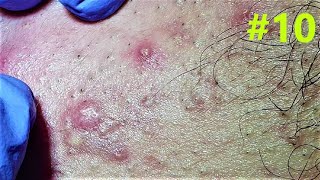 BLACKHEADS EXTRACTIONS on Happy  10 [upl. by Hagood]