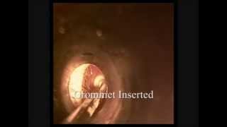 Myringotomy amp Grommet Insertion for Atelectasis  Hearing Loss [upl. by Ttereve137]