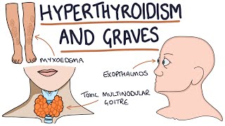 Graves Disease  Overview causes pathophysiology investigations and treatment [upl. by Aliuqet642]