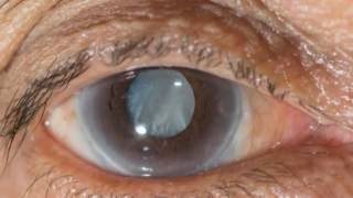 New eye drops may help treat cataracts [upl. by Sholom]