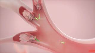 How It Works Zephyr Valve Treatment for COPD amp Emphysema [upl. by Amorete95]