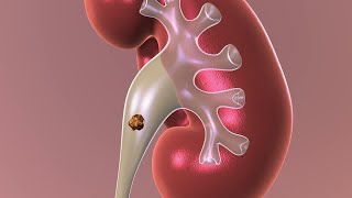 Observation Nonsurgical Approach to Kidney Stones [upl. by Anerehs]