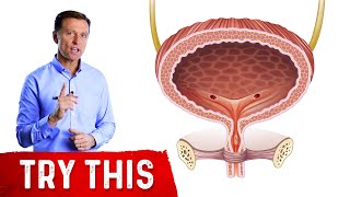 Bladder Cancer Treatment Urinary Diversion  Urology Care Foundation [upl. by Osher]