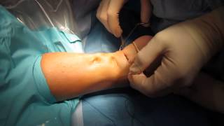 Percutaneous Achilles Tendon Surgery Repair Unedited by Kevin R Stone MD [upl. by Agnola]