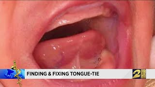 Finding and Fixing Tongue Tie [upl. by Torbart]