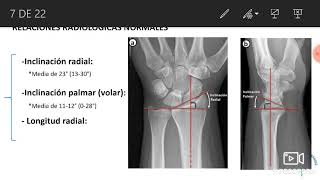 FRACTURAS DE RADIO DISTAL REVISIÓN DEL TEMA [upl. by Atiragram347]