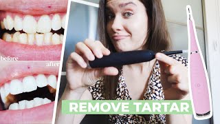 HOW TO REMOVE CALCULUS TARTAR PLAQUE AT HOME  Ultrasonic Tooth Cleaner Review  Does It Work [upl. by Baten]