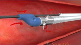 Thrombectomy Catheter  3D Medical Animation [upl. by Zealand]