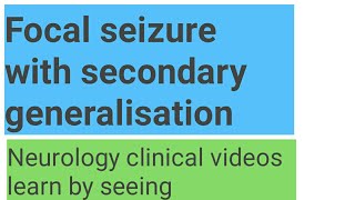 Focal seizure with secondary generalisation [upl. by Cromwell]