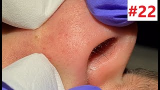 BLACKHEADS EXTRACTIONS on Happys Nose [upl. by Aydni]