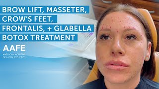 Brow Lift Masseter Frontalis and Glabella Botox Treatment  AAFE [upl. by Llenyaj120]